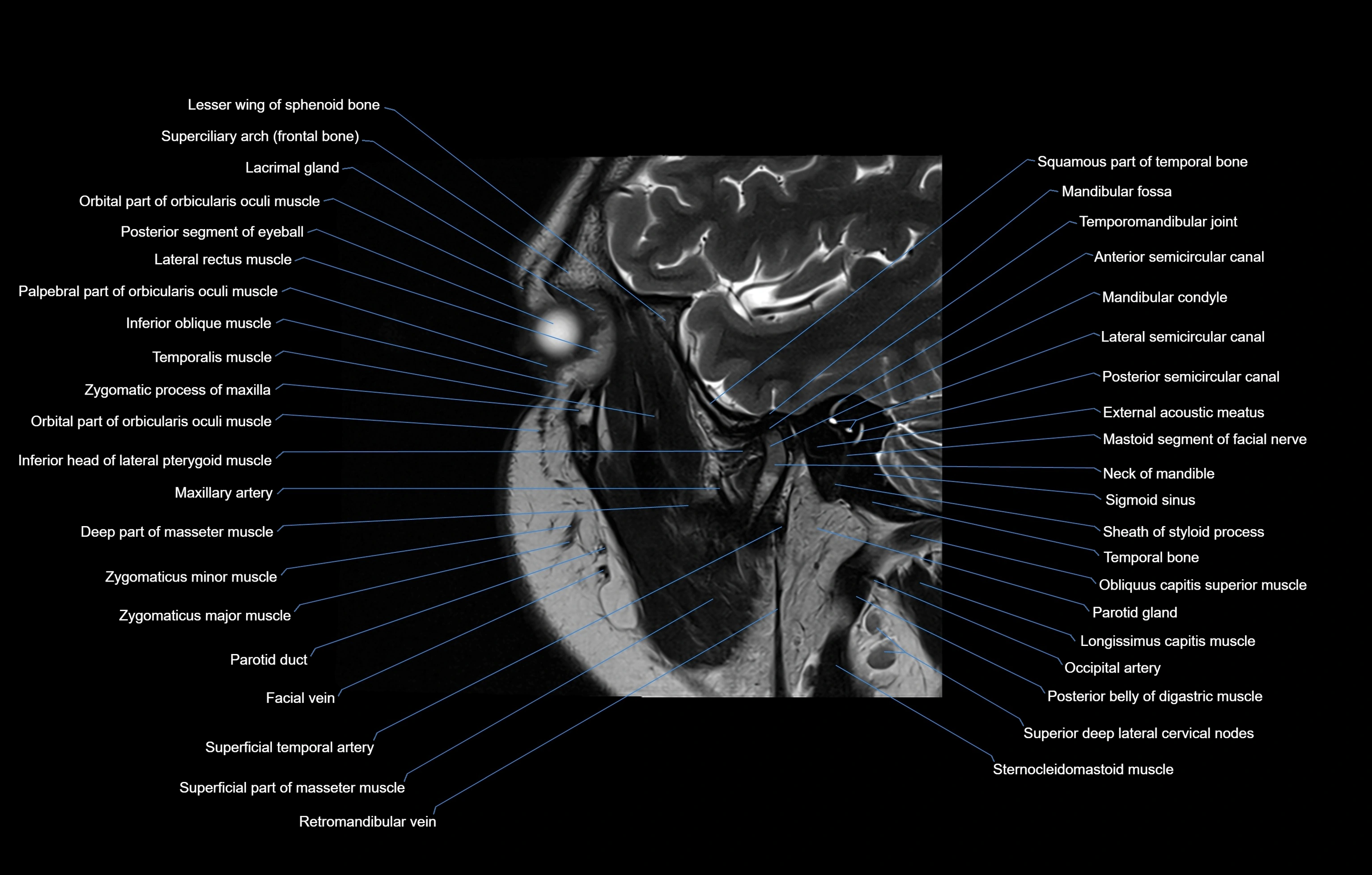 paranasal sinuses(PNS) MRI coronal  cross sectional anatomy 3T radiology  image-img-00001-00018.webp